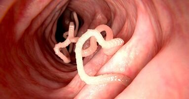 The causes of pests in the human body