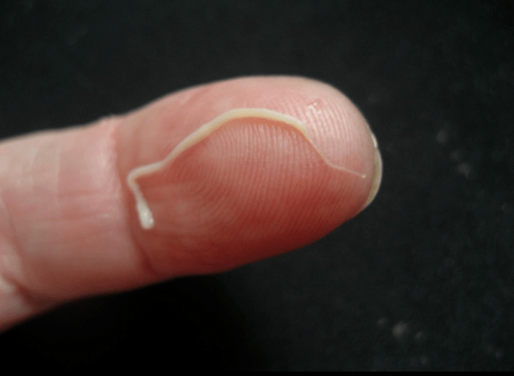 round parasite from the human body